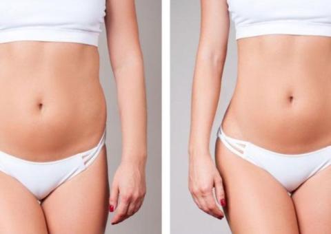 BodyTite: remodelare corporală fără bisturiu