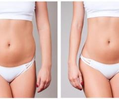 BodyTite: remodelare corporală fără bisturiu